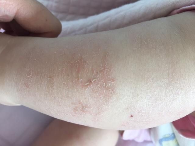 9899缘梦家族长:冬天天气比较干燥,宝宝的皮肤皴裂严重妈妈该怎么